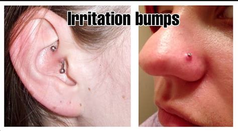 keloid nose piercing|nose piercing keloid vs bump.